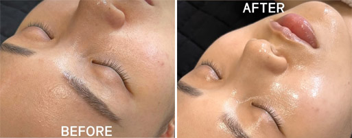 korean nano bb facial before and after